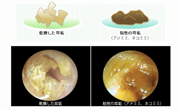 耳垢 くさい